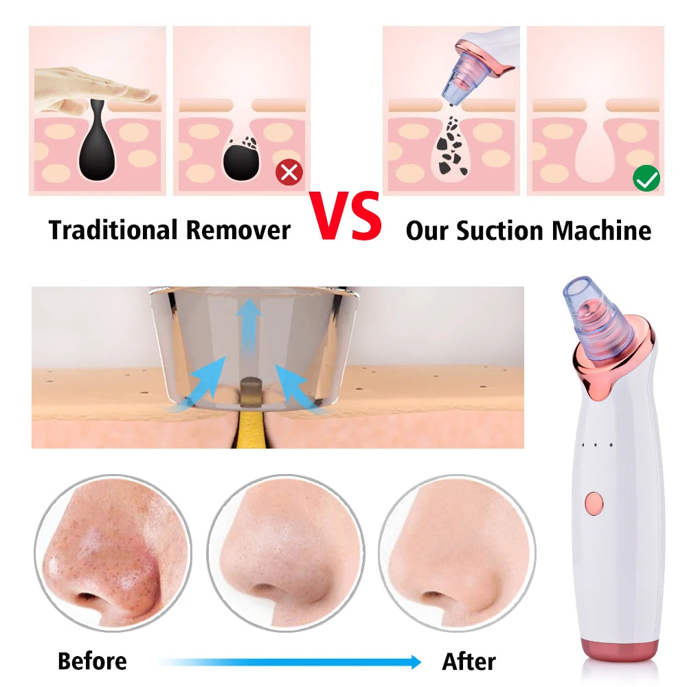 Vacuum Blackhead Remover USB Tool